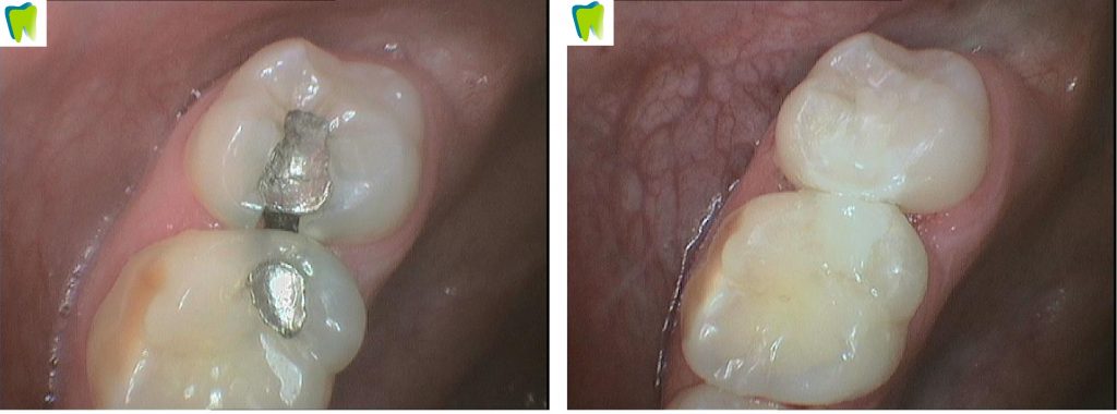 Worn Teeth Repair & Restoration, Ringwood Dental